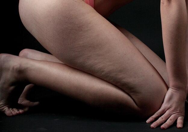 Az 5 legjobb mód a cellulitisz eltávolítására A cellulitisz a nők 80-90%-ának mindig is egy globális probléma. Most, hogy jön a jó idő, a bikini szezon, még égetőbb, hogy megoldást találjunk erre a nem túl szép esztétikai bőrhibára. Szerencsére van néhány módszer, amikkel csökkentheted a narancsbőr m