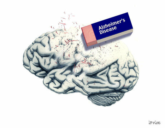 Alzheimer-kór