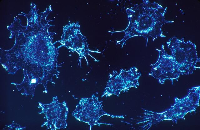 Ezért nem engedik a rák gyógyítását! Közel kétmillió amerikai állampolgárt diagnosztizálnak rákkal évente az Államokban. Ez azt jelenti, hogy minden harmadik embert élete során rákkal diagnosztizálnak, az utóbbi század technikai fejlődése ellenére.