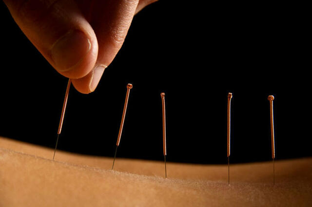 Ha természetes úton szeretnéd megszabadulni a betegségtől és fájdalomtól, próbáld ki az akupunktúrát!