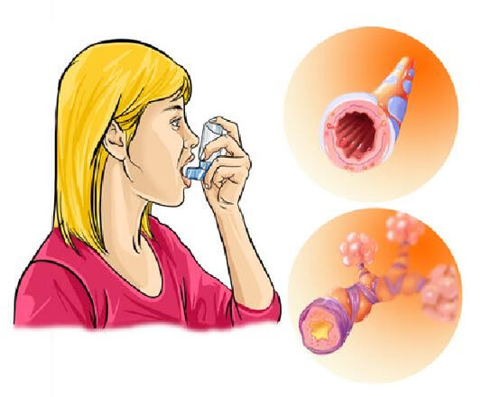 Asztma: tünetegyüttes vagy betegség?