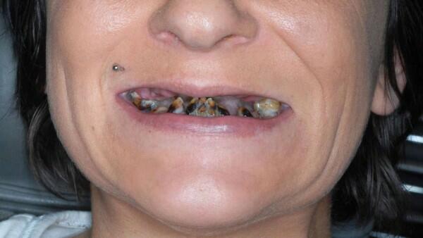 Egy 34 éves német nő annyira betegesen félt a fogorvostól, hogy 15 évig fogat sem mosott. A szájában pedig már csak rohadó csonkok voltak. Mindennek az oka az volt, hogy Nicole-t gyerekkorában durván félrekezelték a fogorvosok.