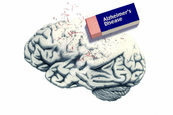 Alzheimer-kór Alzheimer-kór