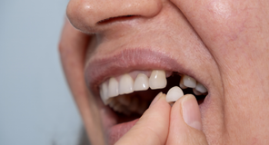 Fogimplantátum Budapest megoldás hiányzó fog pótlására a rágás és emésztés helyreállításáért