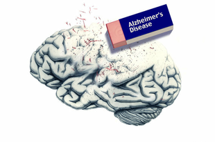 Alzheimer-kór Alzheimer-kór